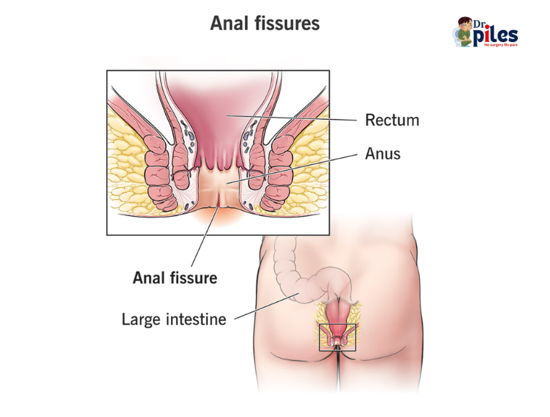 Anal Fissures image