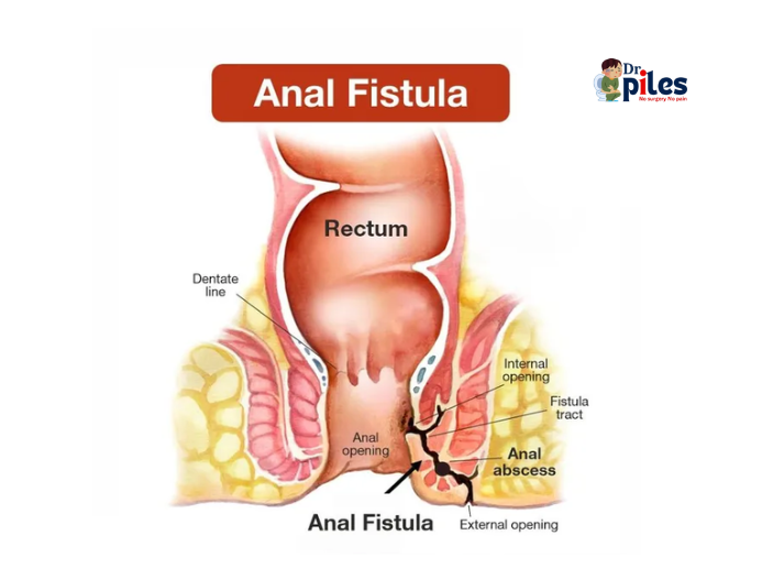 Anal fistula image