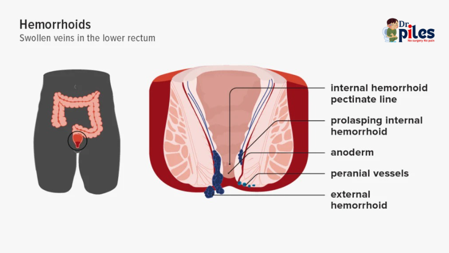 Piles (Hemorrhoids) image