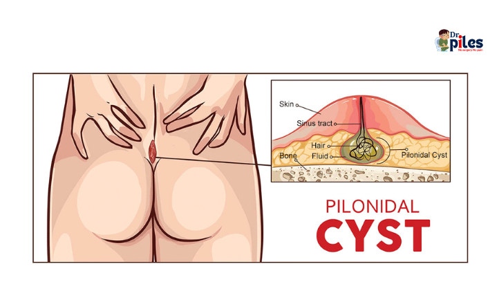 Pilonidal Cyst image
