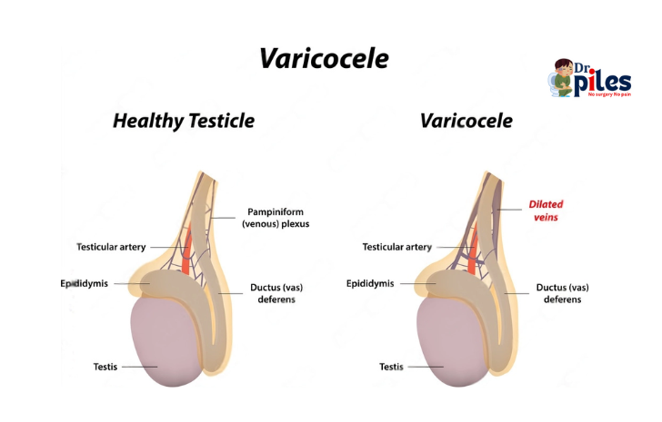 Varicocele image