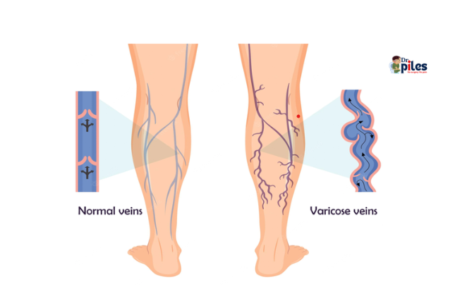 Varicose Veins image